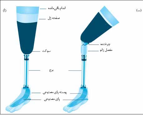 کاشت اندام مصنوعی